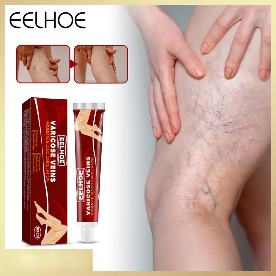 كريم علاج لدوالي eelhoe
